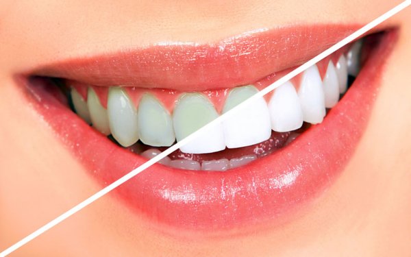 5 ответов по отбеливанию зубов